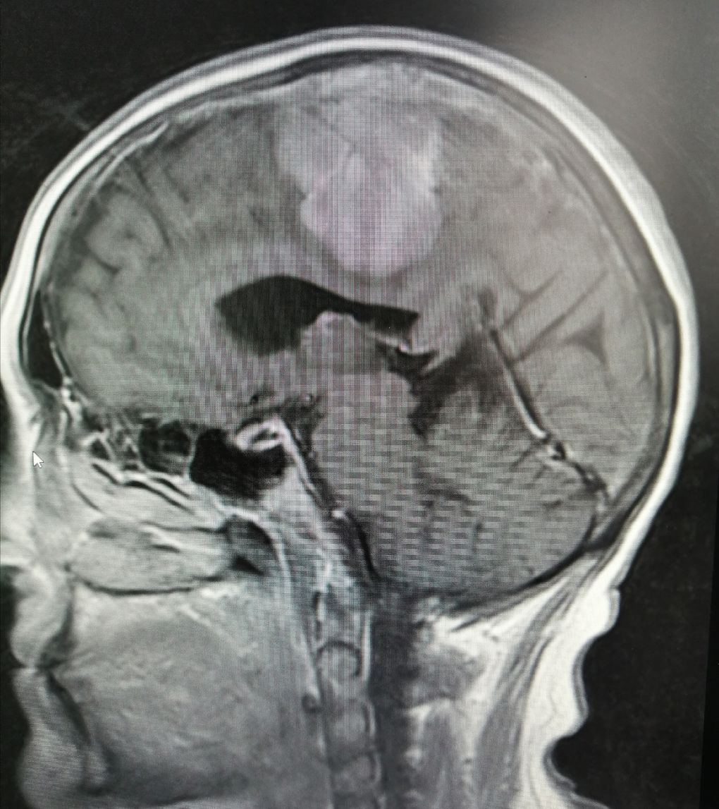 Нейрохирурги Ижевска удалили у пациентки крупную опухоль головного мозга