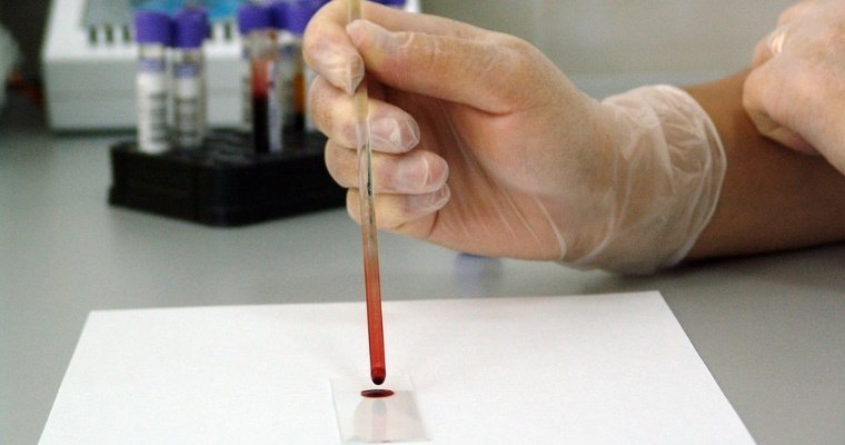 171 человек находится под наблюдением врачей в Удмуртии из-за коронавируса