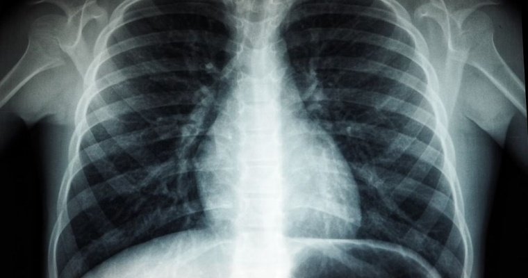 В Удмуртии за 11 месяцев выявлено почти 500 новых случаев рака лёгких