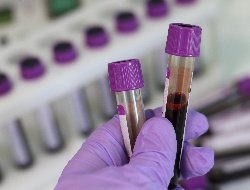 Еще 20 новых случаев заражения коронавирусом выявили в Удмуртии