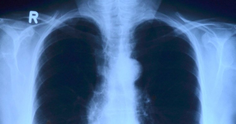 Положительную тенденцию снижения заболеваемости туберкулёзом отметили в Удмуртии