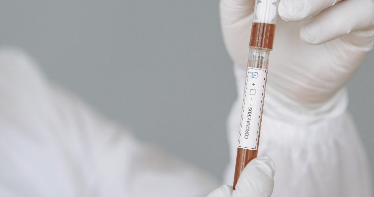 В Удмуртии выявили еще 25 случаев заражения коронавирусом