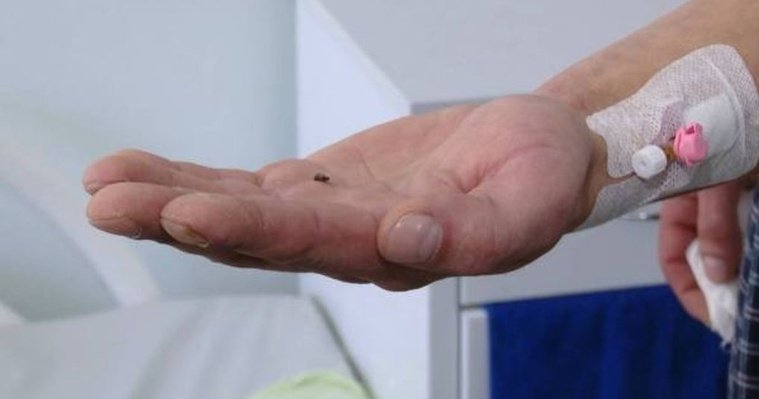 Хирурги Ижевска извлекли осколок гранаты из ноги участника СВО