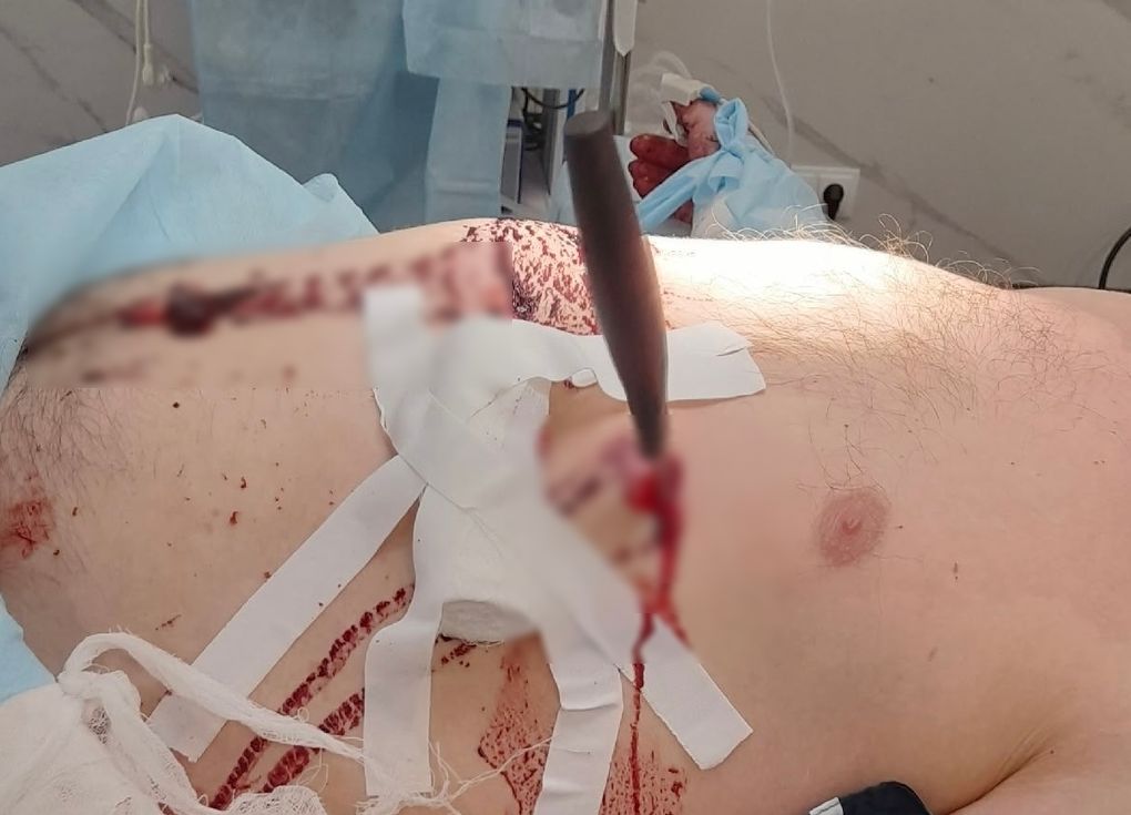 Хирурги в Глазове спасли мужчину после удара ножом в сердце