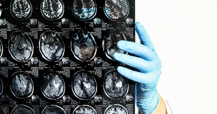 Ученые из Великобритании рассказали о старении мозга на 20 лет после коронавируса 