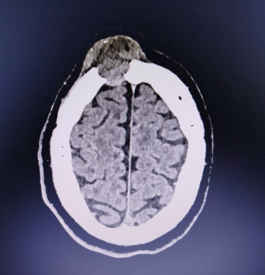 Неудачно ударился: врачи Ижевска удалили у пациента опухоль, которая казалась шишкой