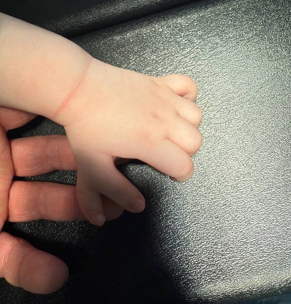 В Удмуртии врачи удалили лишние пальцы на обеих руках годовалого малыша