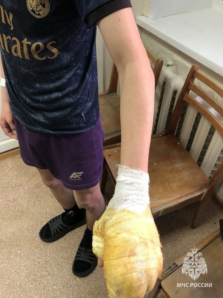 Двое несовершеннолетних пострадали в Ижевске от петард