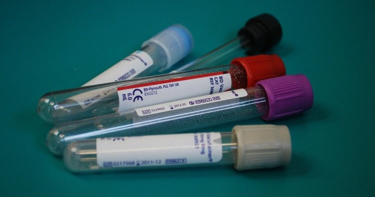 Еще 20 человек в Удмуртии заболели коронавирусом