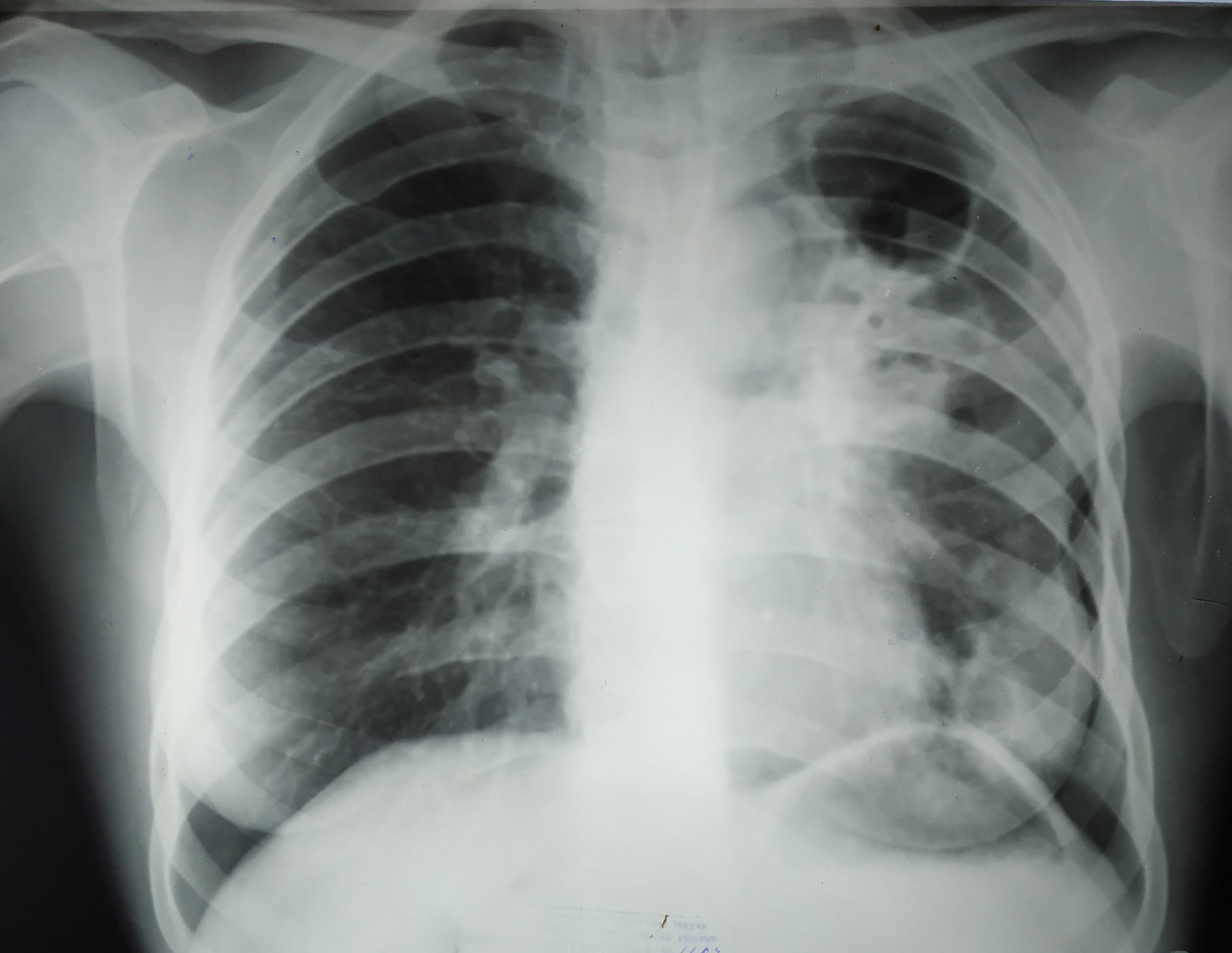 В Удмуртии 2 человека умерли от туберкулеза в 2019 году