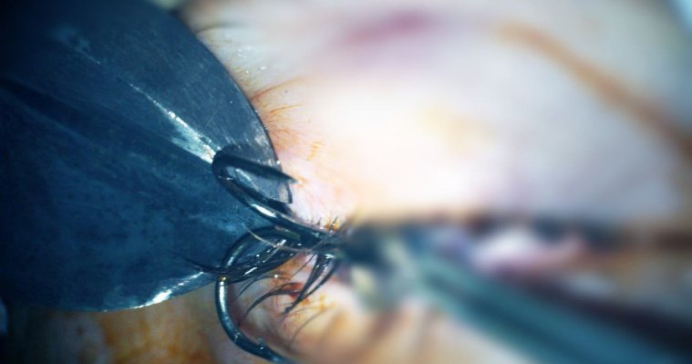 Житель Удмуртии проткнул себе глаз рыболовным крючком