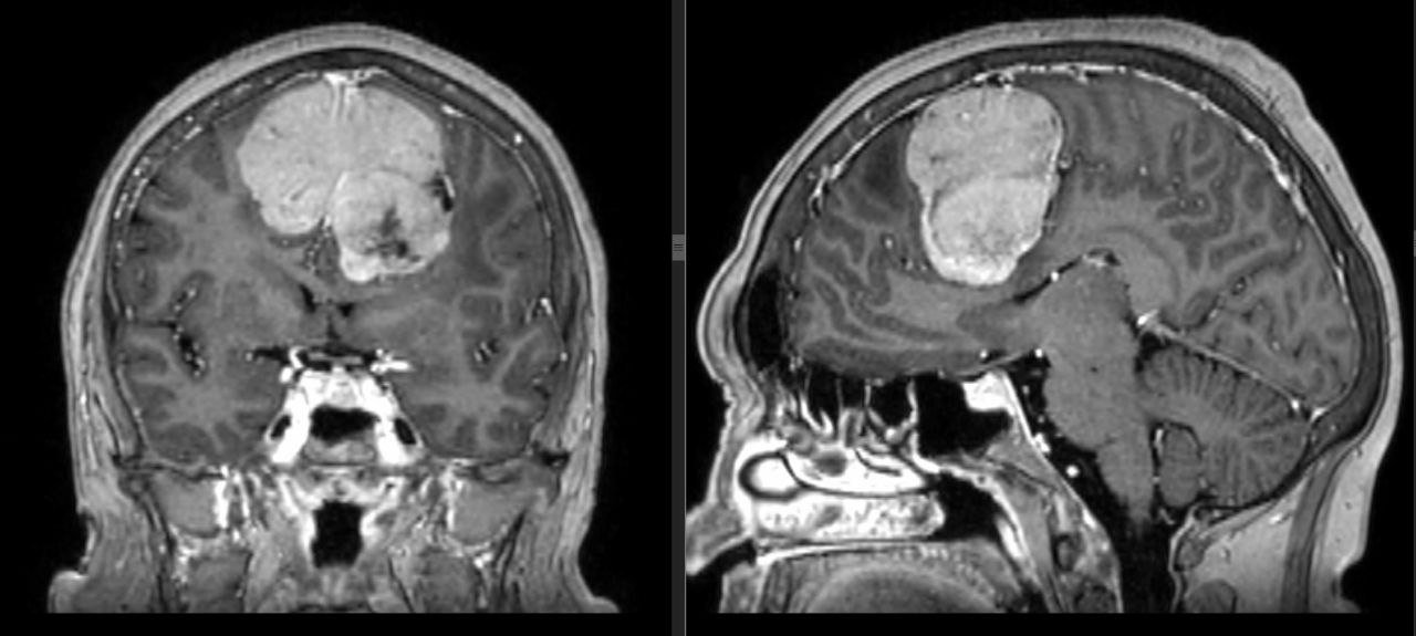 Врачи Ижевска удалили гигантскую опухоль головного мозга у 60-летней женщины