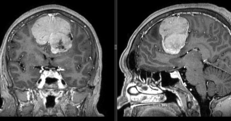 Врачи Ижевска удалили гигантскую опухоль головного мозга у 60-летней женщины 