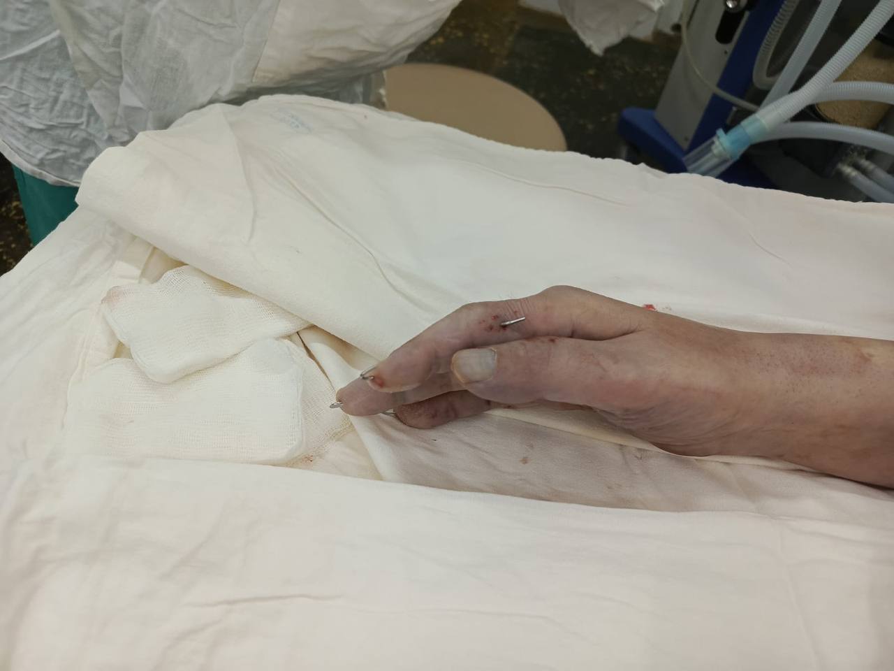 В Удмуртии хирургам ГКБ 6 удалось спасти от инвалидности бойца СВО