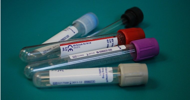 Еще 81 случай коронавирусной инфекции выявили в Удмуртии