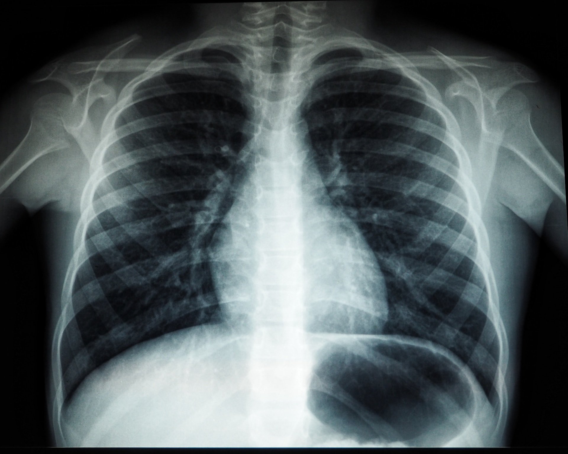 За три первых месяца 2023 года у 2,5 тысячи жителей Удмуртии выявили болезни органов дыхания