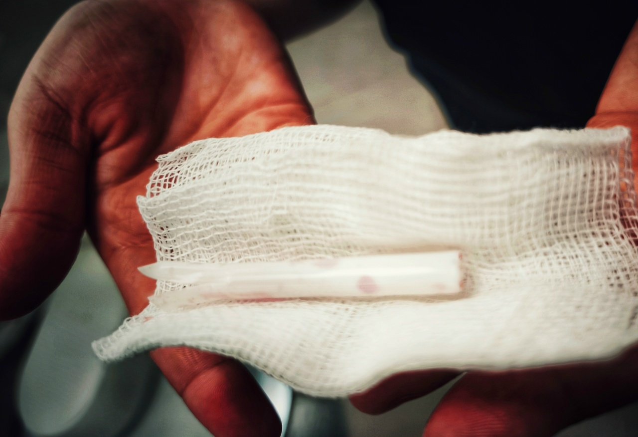 В Ижевске врачи извлекли из вены пациента обломок медицинской трубки